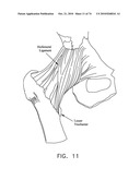 METHOD AND APPARATUS FOR ACCESSING THE INTERIOR OF A HIP JOINT, INCLUDING THE PROVISION AND USE OF A NOVEL TELESCOPING ACCESS CANNULA AND A NOVEL TELESCOPING OBTURATOR diagram and image