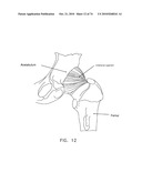 METHOD AND APPARATUS FOR ACCESSING THE INTERIOR OF A HIP JOINT, INCLUDING THE PROVISION AND USE OF A NOVEL TELESCOPING ACCESS CANNULA AND A NOVEL TELESCOPING OBTURATOR diagram and image