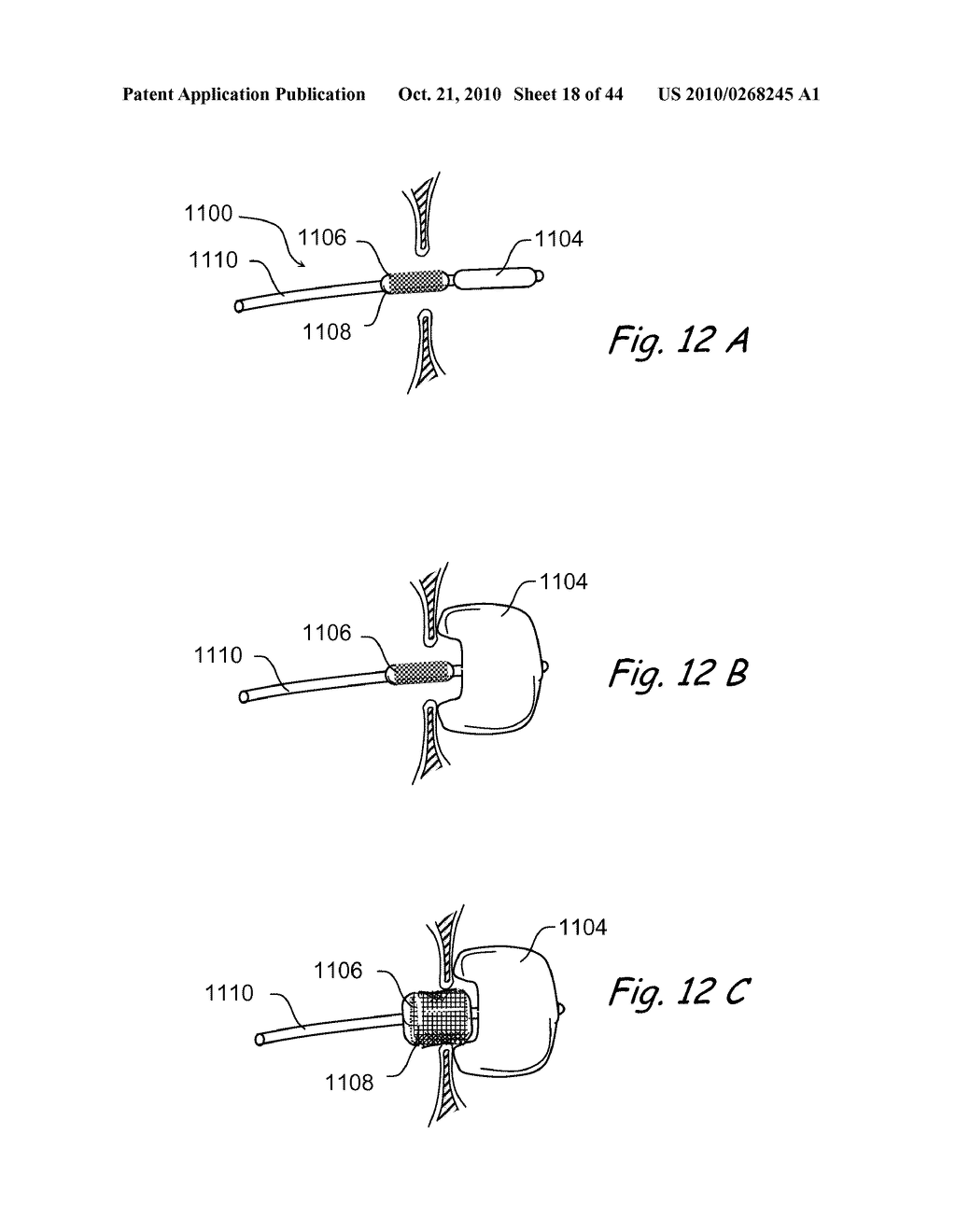 Devices, Systems and Methods for Treating Disorders of the Ear, Nose and Throat - diagram, schematic, and image 19