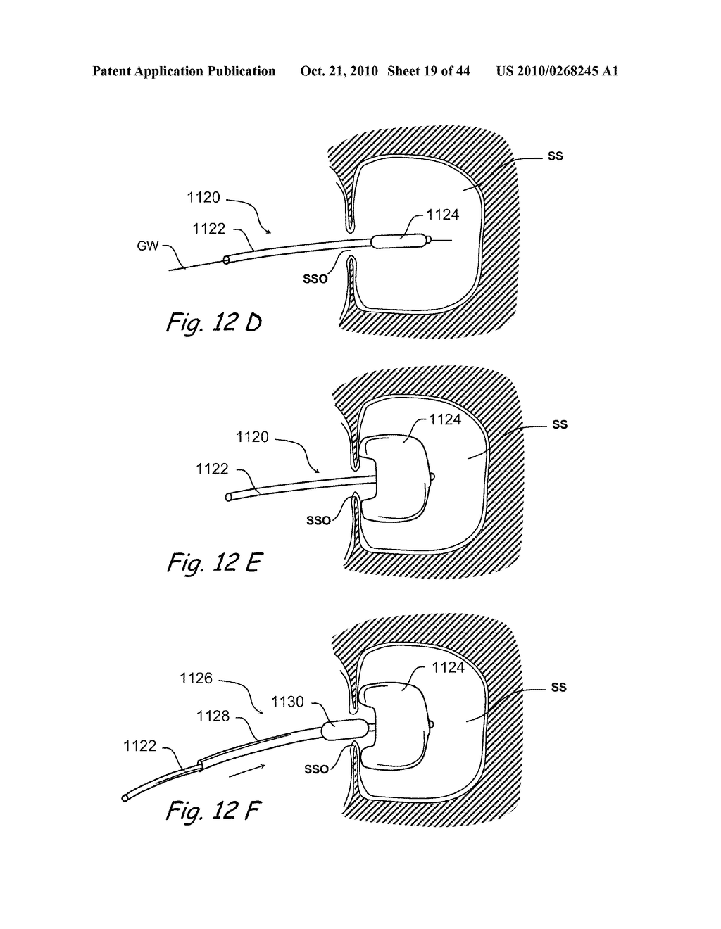 Devices, Systems and Methods for Treating Disorders of the Ear, Nose and Throat - diagram, schematic, and image 20