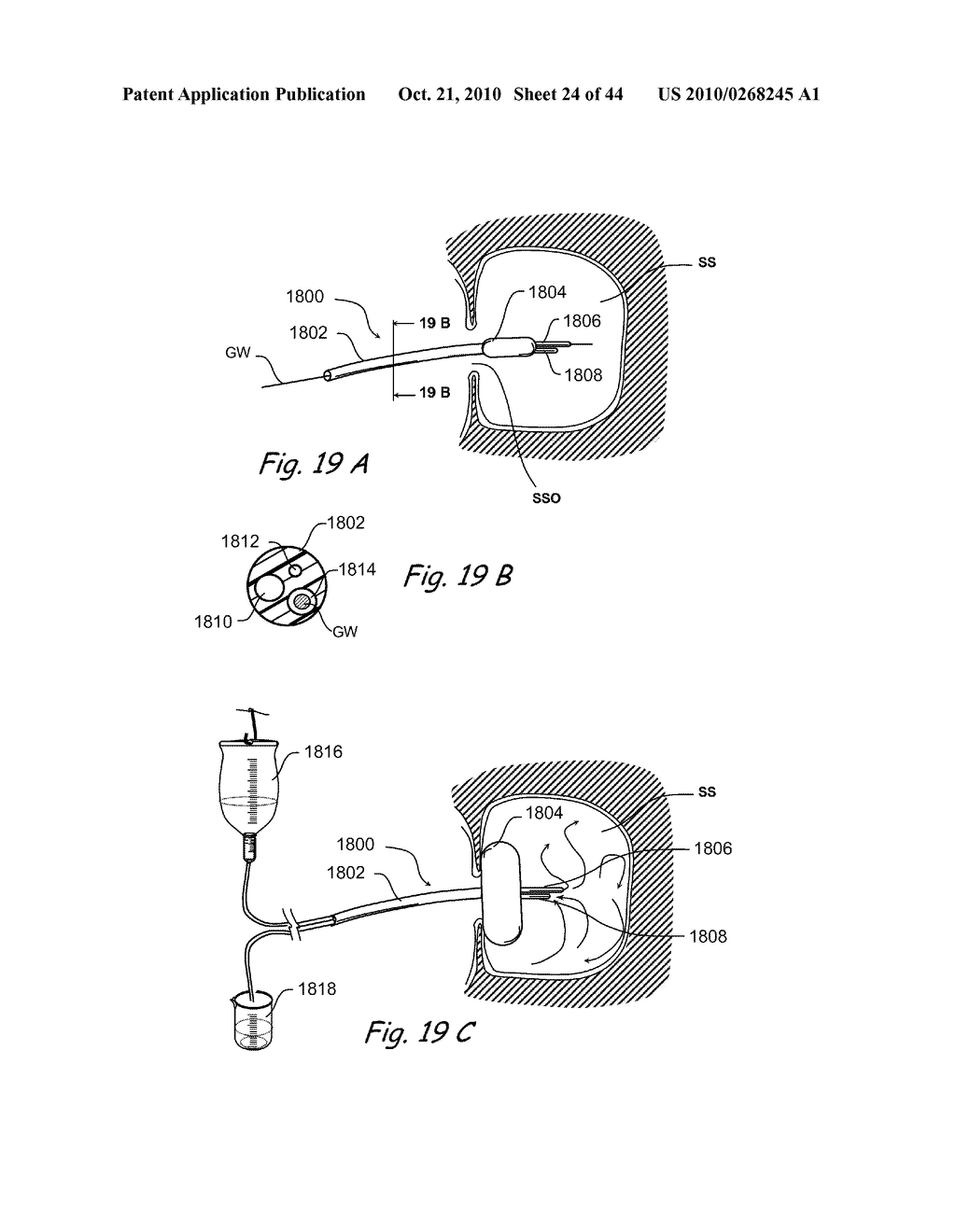 Devices, Systems and Methods for Treating Disorders of the Ear, Nose and Throat - diagram, schematic, and image 25