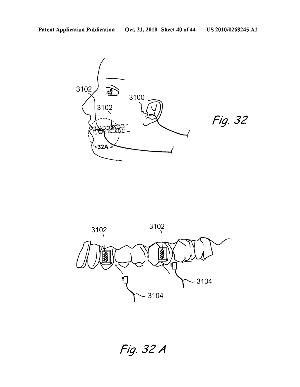 Devices, Systems and Methods for Treating Disorders of the Ear, Nose and Throat - diagram, schematic, and image 41