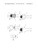 Method and apparatus for restricting flow through an opening in the side wall of a body lumen, and/or for reinforcing a weakness in the side wall of a body lumen, while still maintaining substantially normal flow through the body lumen diagram and image