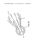 Method and apparatus for restricting flow through an opening in the side wall of a body lumen, and/or for reinforcing a weakness in the side wall of a body lumen, while still maintaining substantially normal flow through the body lumen diagram and image