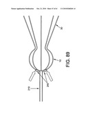 Method and apparatus for restricting flow through an opening in the side wall of a body lumen, and/or for reinforcing a weakness in the side wall of a body lumen, while still maintaining substantially normal flow through the body lumen diagram and image