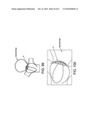 Method and apparatus for restricting flow through an opening in the side wall of a body lumen, and/or for reinforcing a weakness in the side wall of a body lumen, while still maintaining substantially normal flow through the body lumen diagram and image