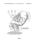 Duodenal Stimulation To Induce Satiety diagram and image