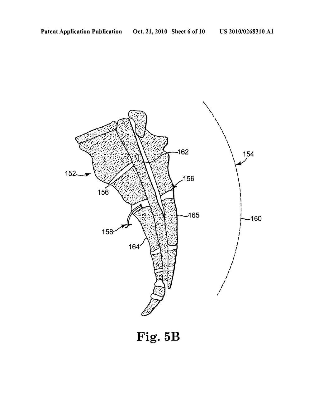 IMPLANTABLE MEDICAL ELECTRICAL STIMULATION LEAD, SUCH AS PNE LEAD, AND METHOD OF USE - diagram, schematic, and image 07