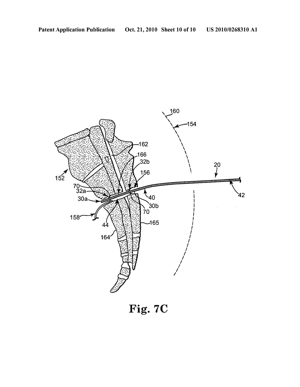 IMPLANTABLE MEDICAL ELECTRICAL STIMULATION LEAD, SUCH AS PNE LEAD, AND METHOD OF USE - diagram, schematic, and image 11