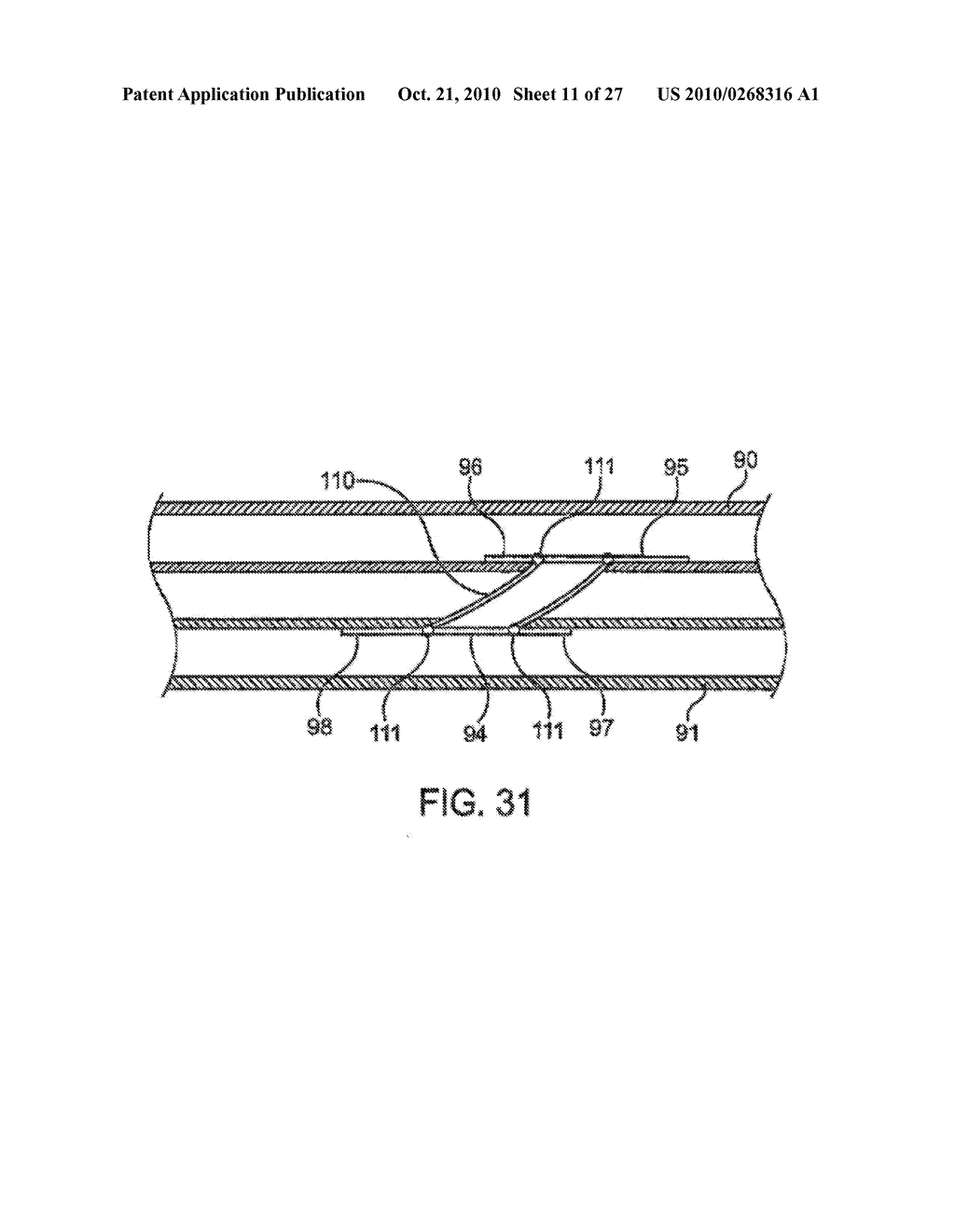 DEVICE AND METHOD FOR ESTABLISHING AN ARTIFICIAL ARTERIO-VENOUS FISTULA - diagram, schematic, and image 12