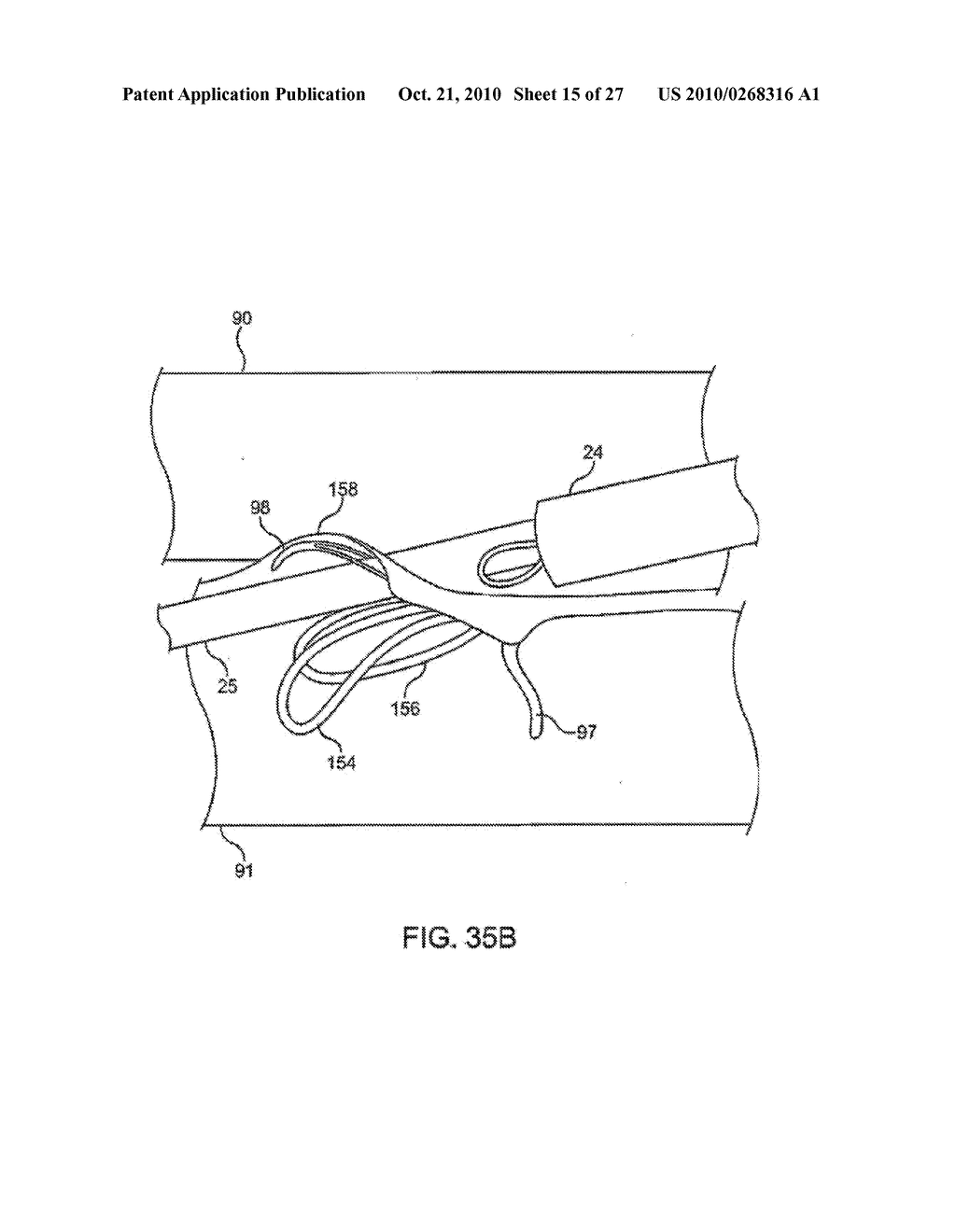 DEVICE AND METHOD FOR ESTABLISHING AN ARTIFICIAL ARTERIO-VENOUS FISTULA - diagram, schematic, and image 16