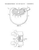 Minimally Invasive Expandable Contained Vertebral Implant and Method diagram and image
