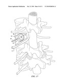 Minimally Invasive Expandable Contained Vertebral Implant and Method diagram and image