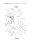 MINIMALLY INVASIVE EXPANDABLE VERTEBRAL IMPLANT AND METHOD diagram and image