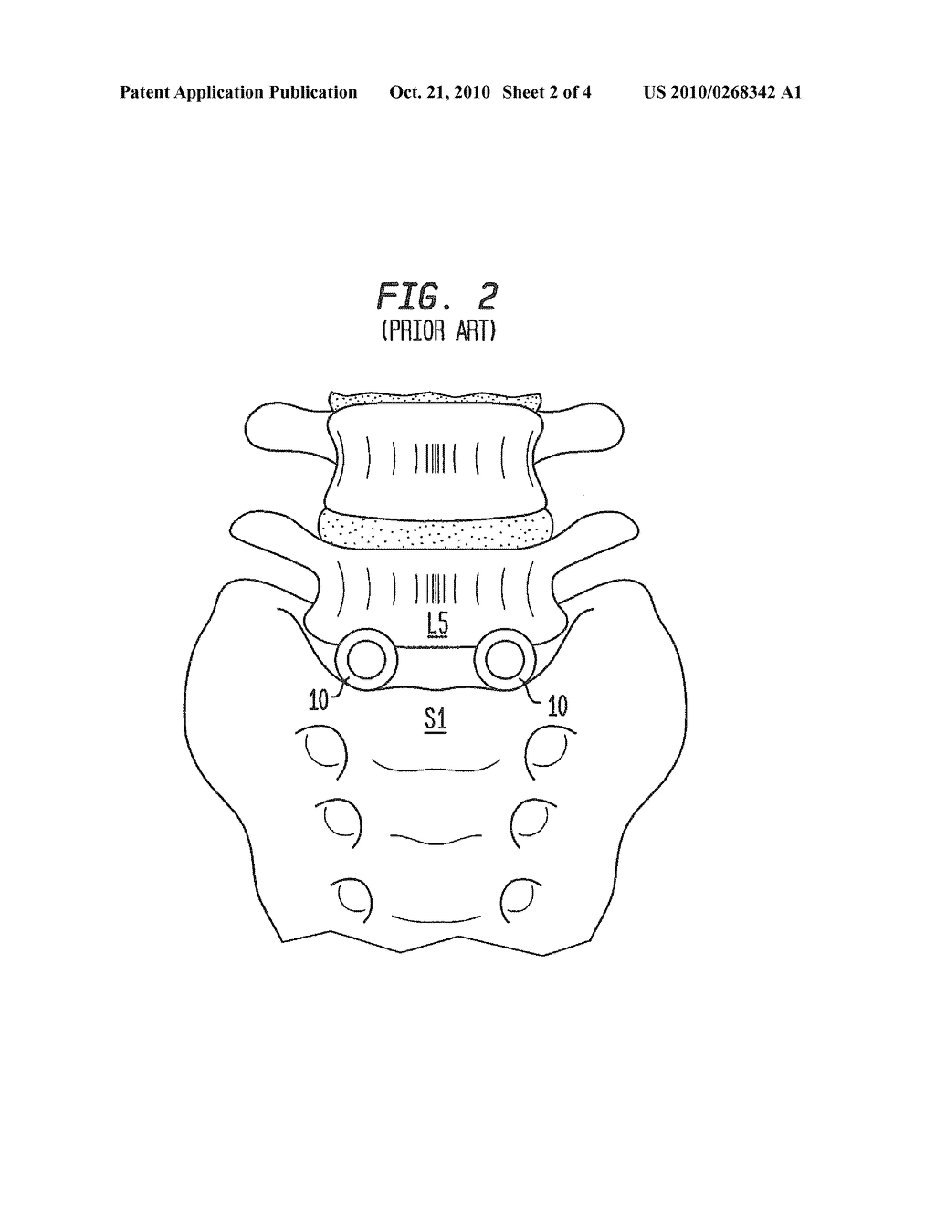 INTERVERTEBRAL SPACER DEVICE HAVING A SLOTTED PARTIAL CIRCULAR DOMED ARCH STRIP SPRING - diagram, schematic, and image 03