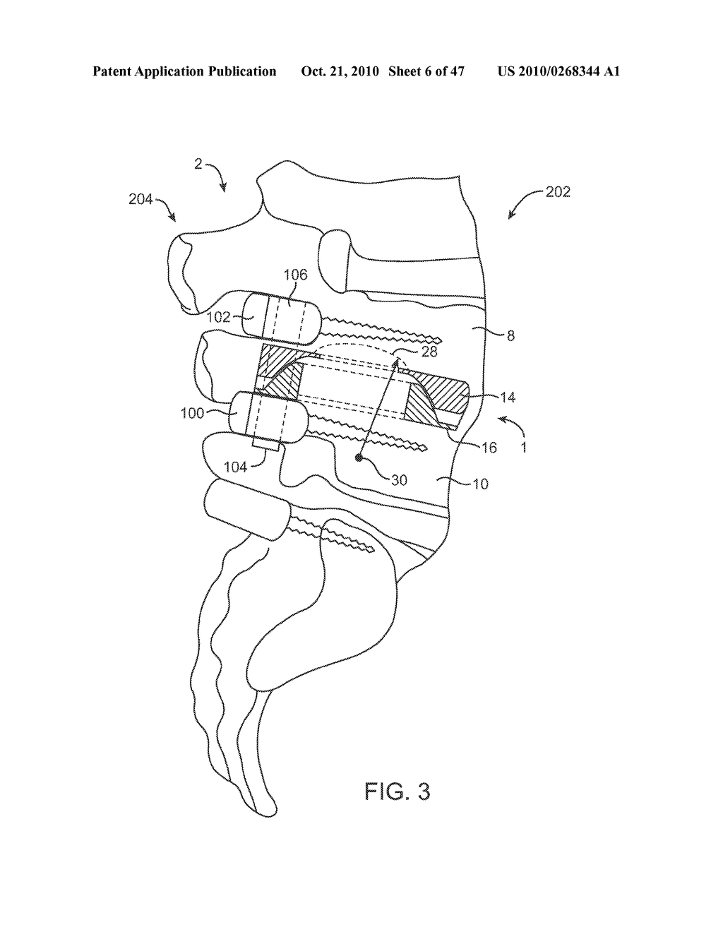 Posterior Spinal Device and Method - diagram, schematic, and image 07