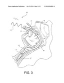 Fluid Removing Apparatus for Respiratory Tract diagram and image