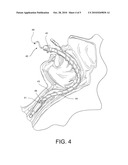 Fluid Removing Apparatus for Respiratory Tract diagram and image