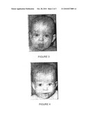 USE OF A BETA BLOCKER FOR THE MANUFACTURE OF A MEDICAMENT FOR THE TREATMENT OF HEMANGIOMAS diagram and image