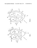 CARDIAC SUPPORT DEVICE diagram and image