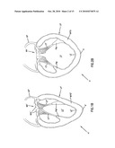 CARDIAC SUPPORT DEVICE diagram and image