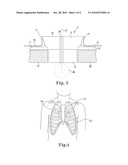 Minimally Invasive Access Device for Heart Valve Procedures diagram and image