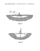 WOUND CLEANSING APPARATUS WITH SCAFFOLD diagram and image