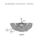 WOUND CLEANSING APPARATUS WITH SCAFFOLD diagram and image