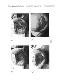 Pulsed electromagnetic field and negative pressure therapy wound treatment method and system diagram and image