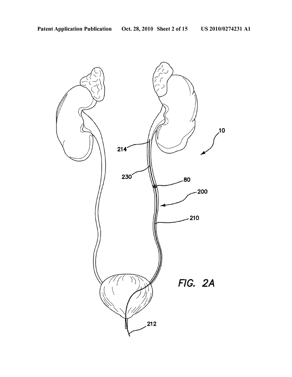 RENAL FLUSHING CATHETER - diagram, schematic, and image 03