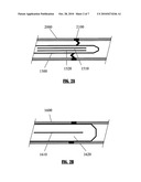 EXPANDABLE INTRAMEDULLARY NAIL FOR SMALL BONE FIXATION diagram and image