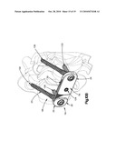 ADAPTABLE BONE FIXATION PLATE diagram and image