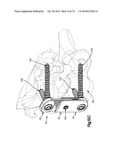 ADAPTABLE BONE FIXATION PLATE diagram and image