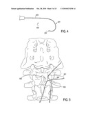 TISSUE MODIFICATION DEVICES AND METHODS diagram and image