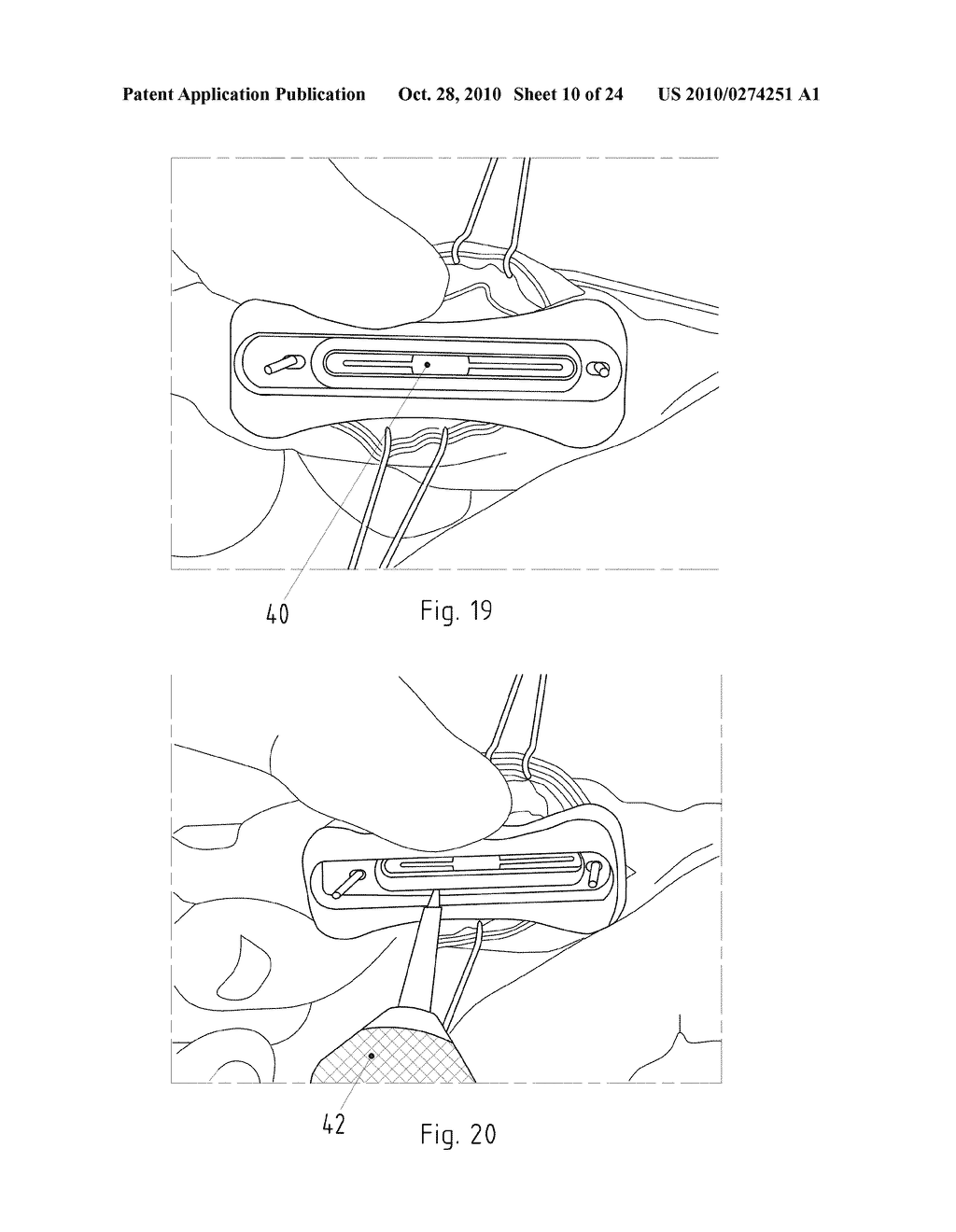 Instruments for Carrying Out an Operating Procedure on a Joint - diagram, schematic, and image 11