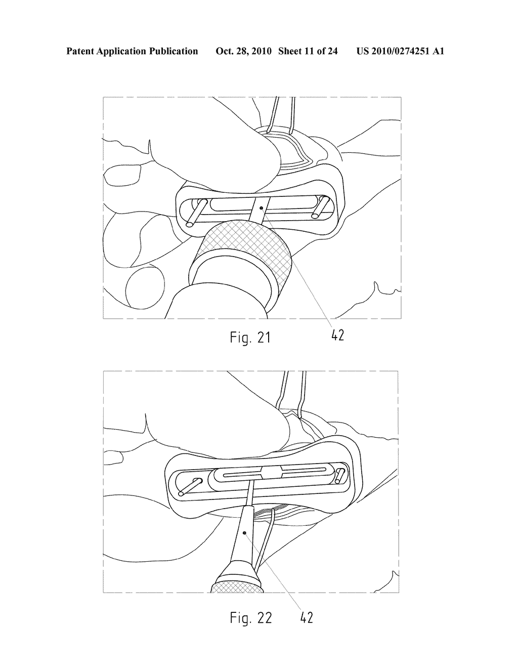 Instruments for Carrying Out an Operating Procedure on a Joint - diagram, schematic, and image 12