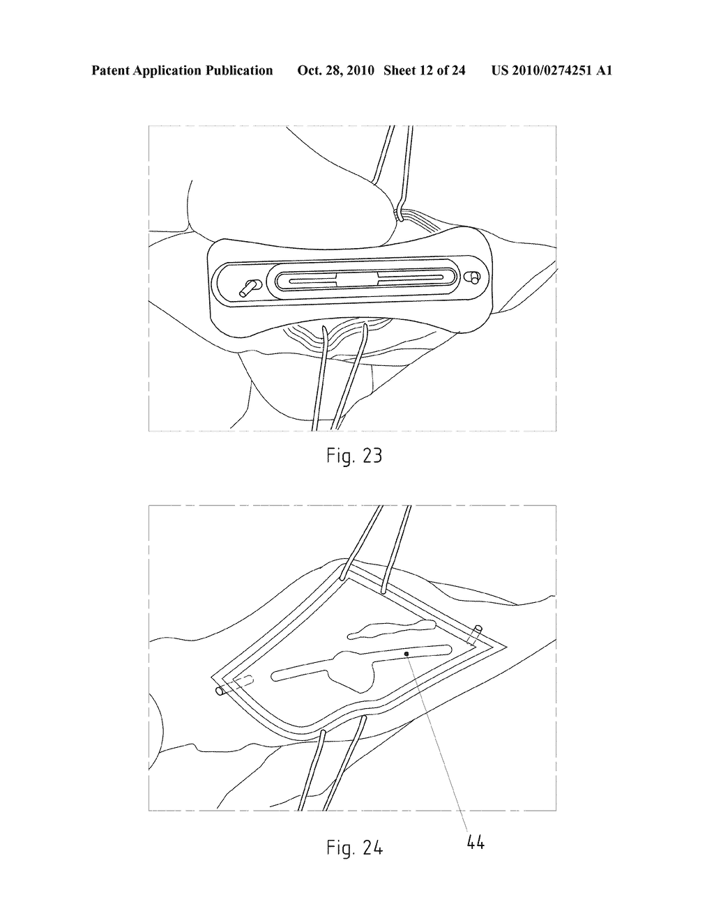 Instruments for Carrying Out an Operating Procedure on a Joint - diagram, schematic, and image 13