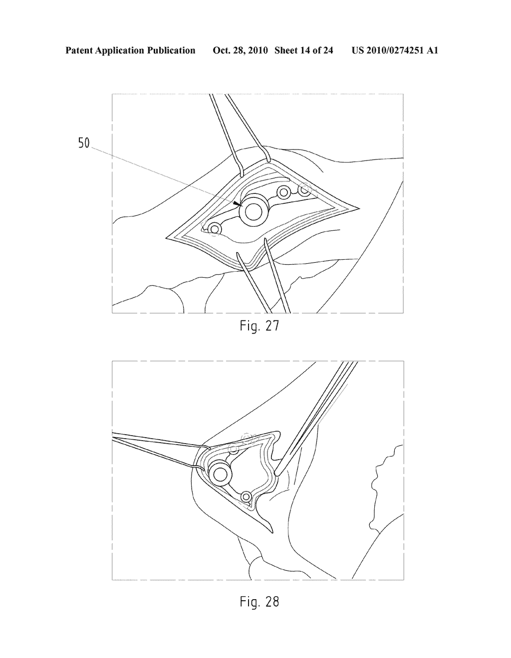 Instruments for Carrying Out an Operating Procedure on a Joint - diagram, schematic, and image 15