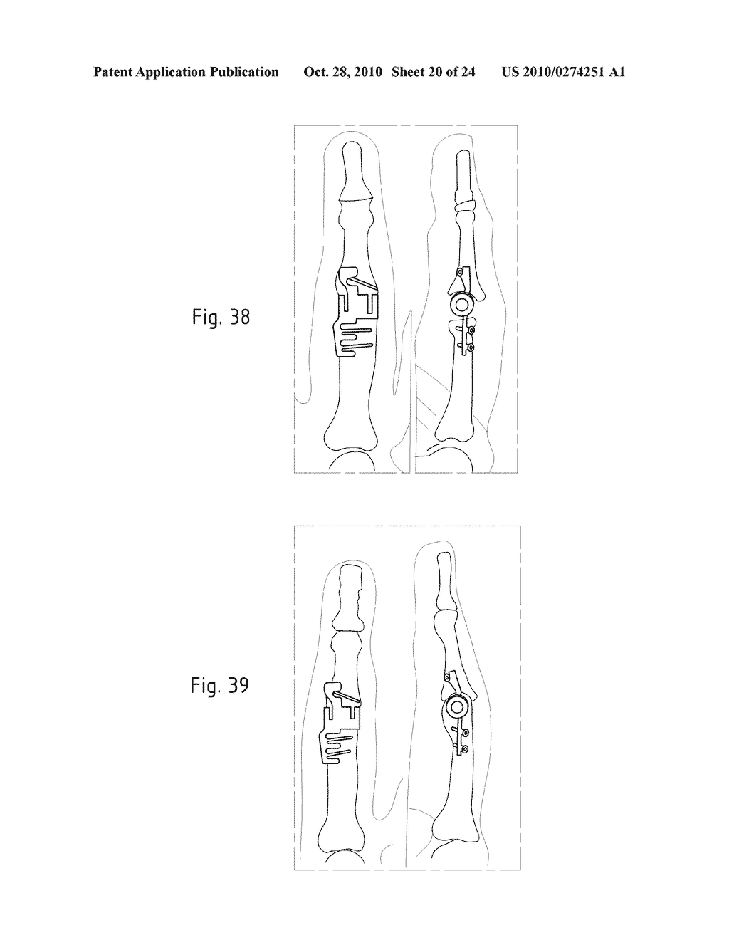 Instruments for Carrying Out an Operating Procedure on a Joint - diagram, schematic, and image 21