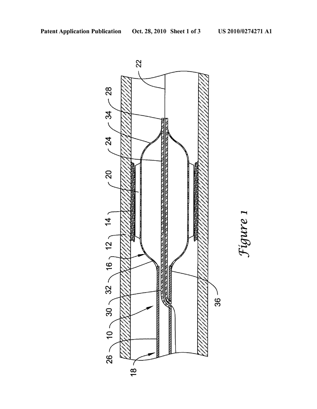 CUTTING BALLOON CATHETER AND METHOD FOR BLADE MOUNTING - diagram, schematic, and image 02