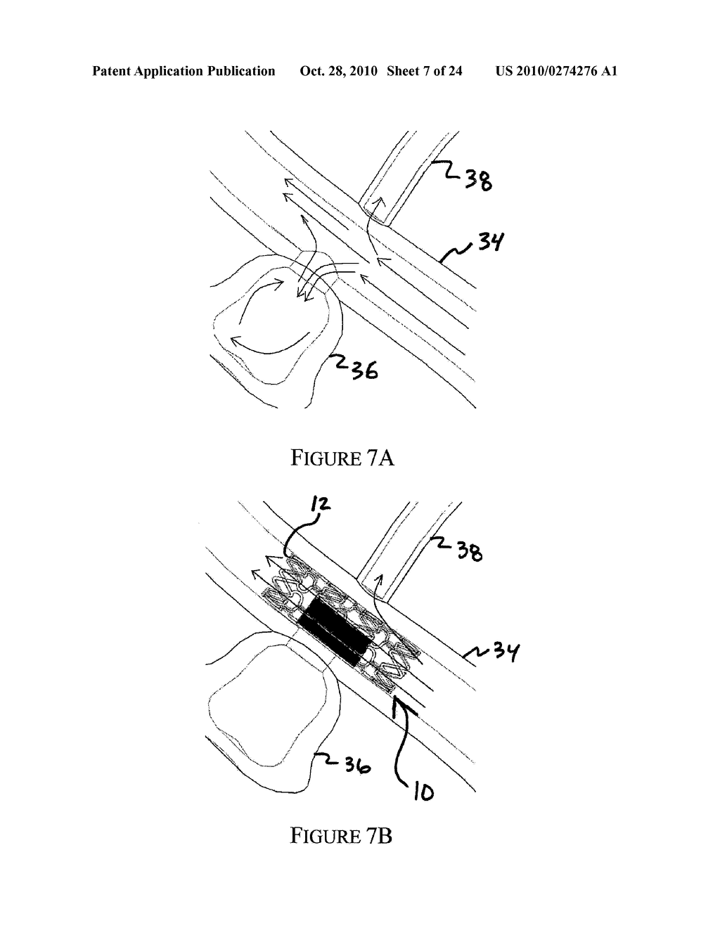 ANEURYSM TREATMENT SYSTEM, DEVICE AND METHOD - diagram, schematic, and image 08