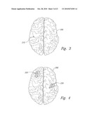 METHOD AND APPARATUS FOR ELECTRICALLY STIMULATING CELLS IMPLANTED IN THE NERVOUS SYSTEM diagram and image