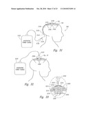 METHOD AND APPARATUS FOR ELECTRICALLY STIMULATING CELLS IMPLANTED IN THE NERVOUS SYSTEM diagram and image