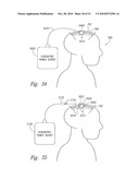 METHOD AND APPARATUS FOR ELECTRICALLY STIMULATING CELLS IMPLANTED IN THE NERVOUS SYSTEM diagram and image