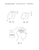 METHOD AND APPARATUS FOR ELECTRICALLY STIMULATING CELLS IMPLANTED IN THE NERVOUS SYSTEM diagram and image