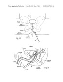 SYSTEMS AND METHODS FOR THE TREATMENT OF BLADDER DYSFUNCTIONS USING NEUROMODULATION diagram and image