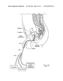 SYSTEMS AND METHODS FOR THE TREATMENT OF BLADDER DYSFUNCTIONS USING NEUROMODULATION diagram and image