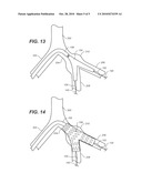 Delivery System for Deployment of a One-Piece Iliac-Branch Device diagram and image