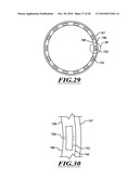 ADJUSTABLE PROSTHESIS diagram and image