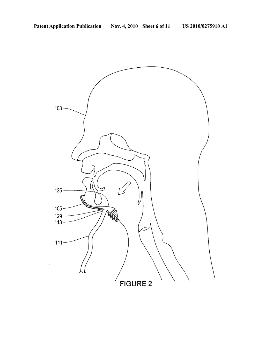 DEVICE AND METHOD FOR OPENING AN AIRWAY - diagram, schematic, and image 07